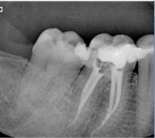 DENTSPLY_UK's tweet photo. "ProTaper Gold creates smooth shaping up to working length, perfect for warm gutta-percha obturation and, at the same time, preserves the original canal anatomy"
Dr Cesar De Gregorio
#ProTaperStories
#ProTaperGold
#PerfectFit
#rootcanalanatomy
#obturation
#endodontics https://t.co/6oLvOMWqf3