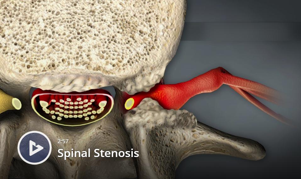 абсолютный и относительный стеноз позвоночного канала мрт. фораминальная грыжа межпозвоночного диска. протрузия l5 l6. фораминальный стеноз поясничного отдела позвоночного. фораминальный стеноз.