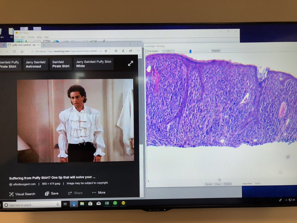 USFDermpath's tweet photo. Puffy shirt sign!! Nervous melanoma much too cellular for those spender rete!! Shoutout to Dr. Diwan! https://t.co/gg4lAtVQwD