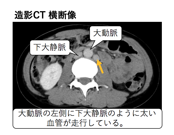 化 大動脈 石灰