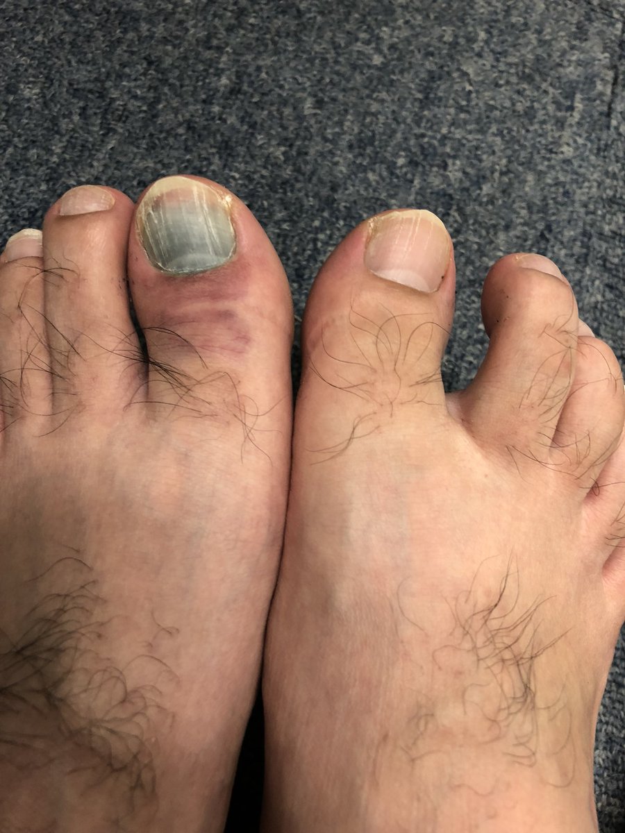 人材派遣営業aj いやー 爪剥がすのとか拷問なんで 縁のない人生でいたかったです 足洗えなくて臭いし 痛いし臭いしで 二重苦です