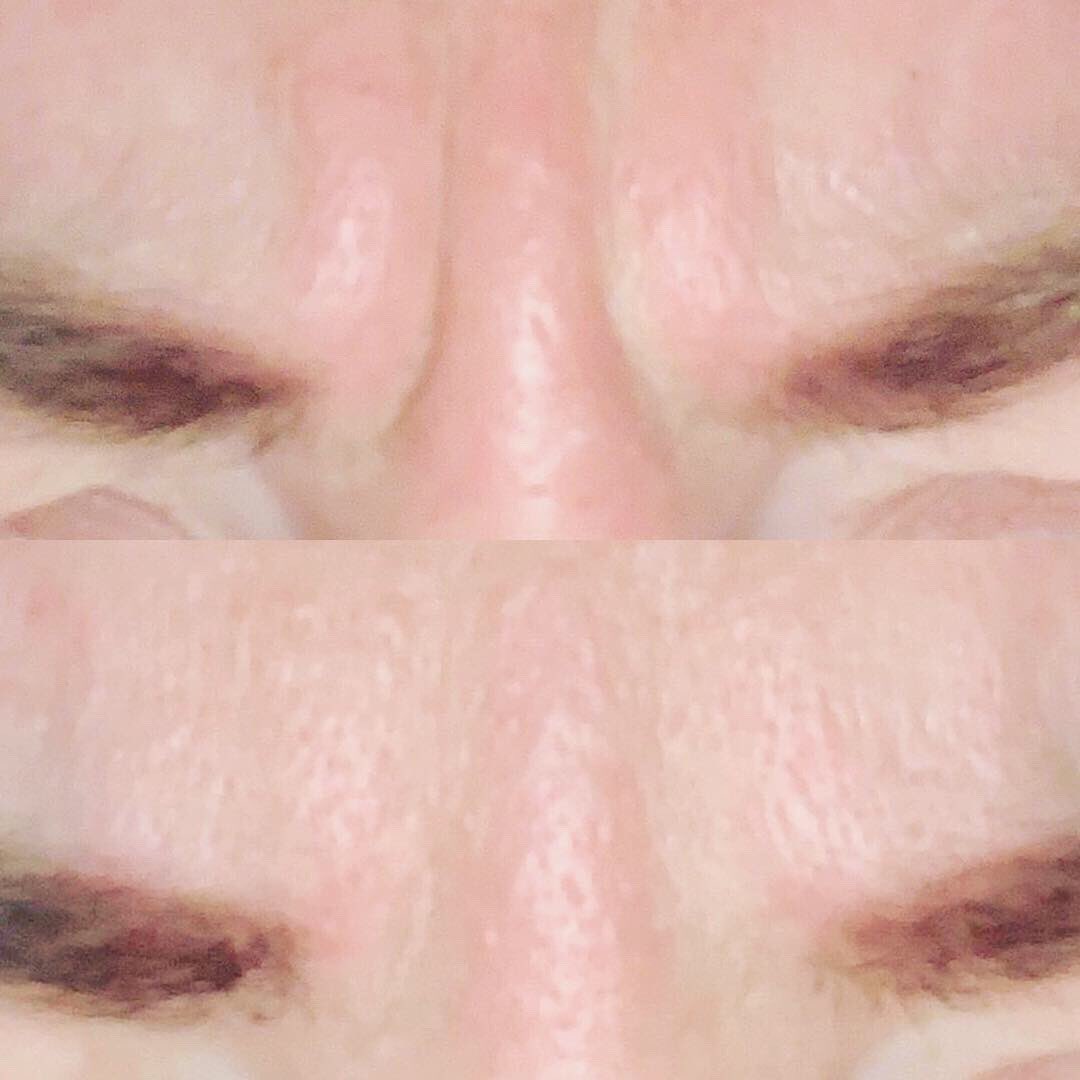 Breezeaestheti1's tweet photo. Forehead (with eyebrow lift) and glabella treated
These results are one week post treatment of this lovely client and she’s very happy with the results
If you’re thinking of a little treatment why not get in touch to discuss your areas of concern and what options are available💉 https://t.co/JV0S9U470e