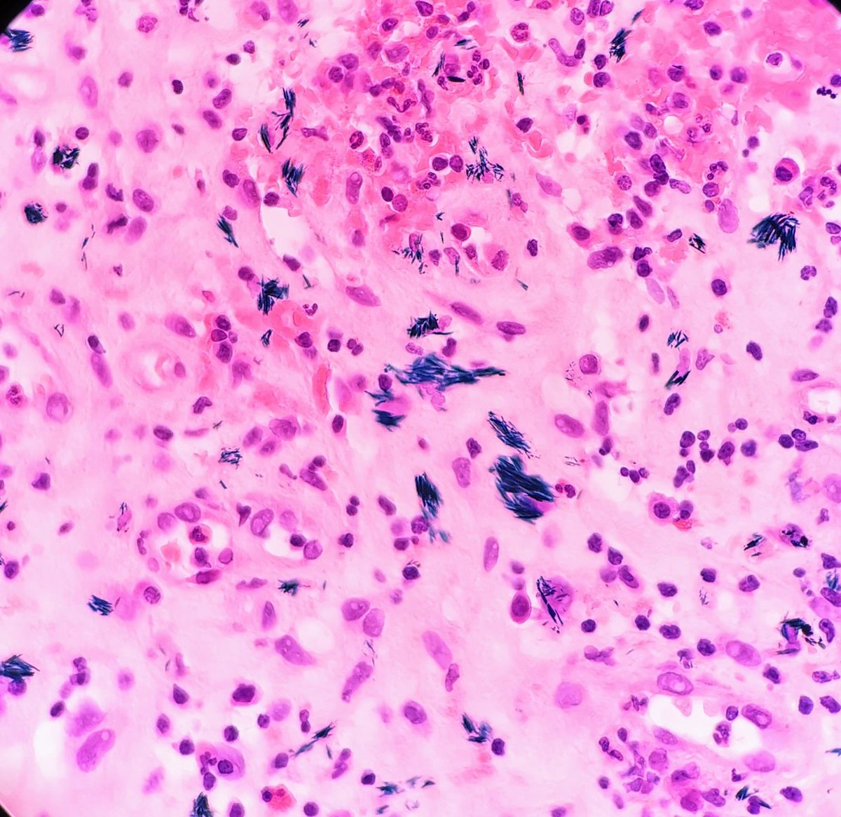 Odd crystals seen in this bladder biopsy - anybody know what they are? #gupath