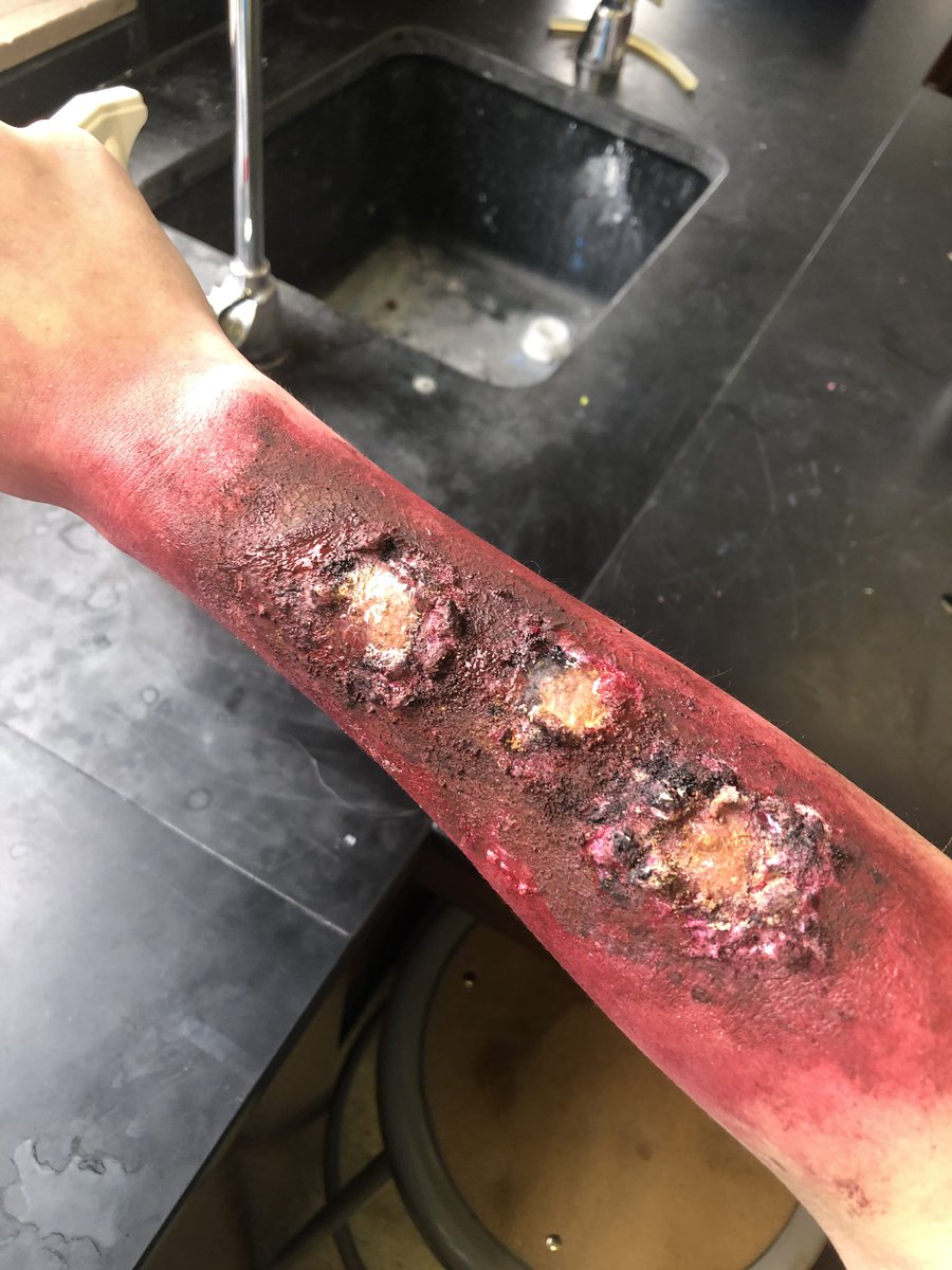 alyssahaller21's tweet photo. #RHSBMS This is our model of a 3rd degree burn. The degree of burn is evident by the reddened skin, charring, blistering, and oily appearance. This burn goes through the epidermis and dermis, and melts the subcutaneous fat (which is what is shining). https://t.co/XR9qet4nxe