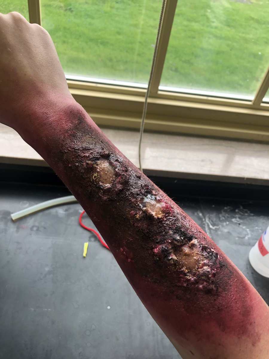 alyssahaller21's tweet photo. #RHSBMS This is our model of a 3rd degree burn. The degree of burn is evident by the reddened skin, charring, blistering, and oily appearance. This burn goes through the epidermis and dermis, and melts the subcutaneous fat (which is what is shining). https://t.co/XR9qet4nxe