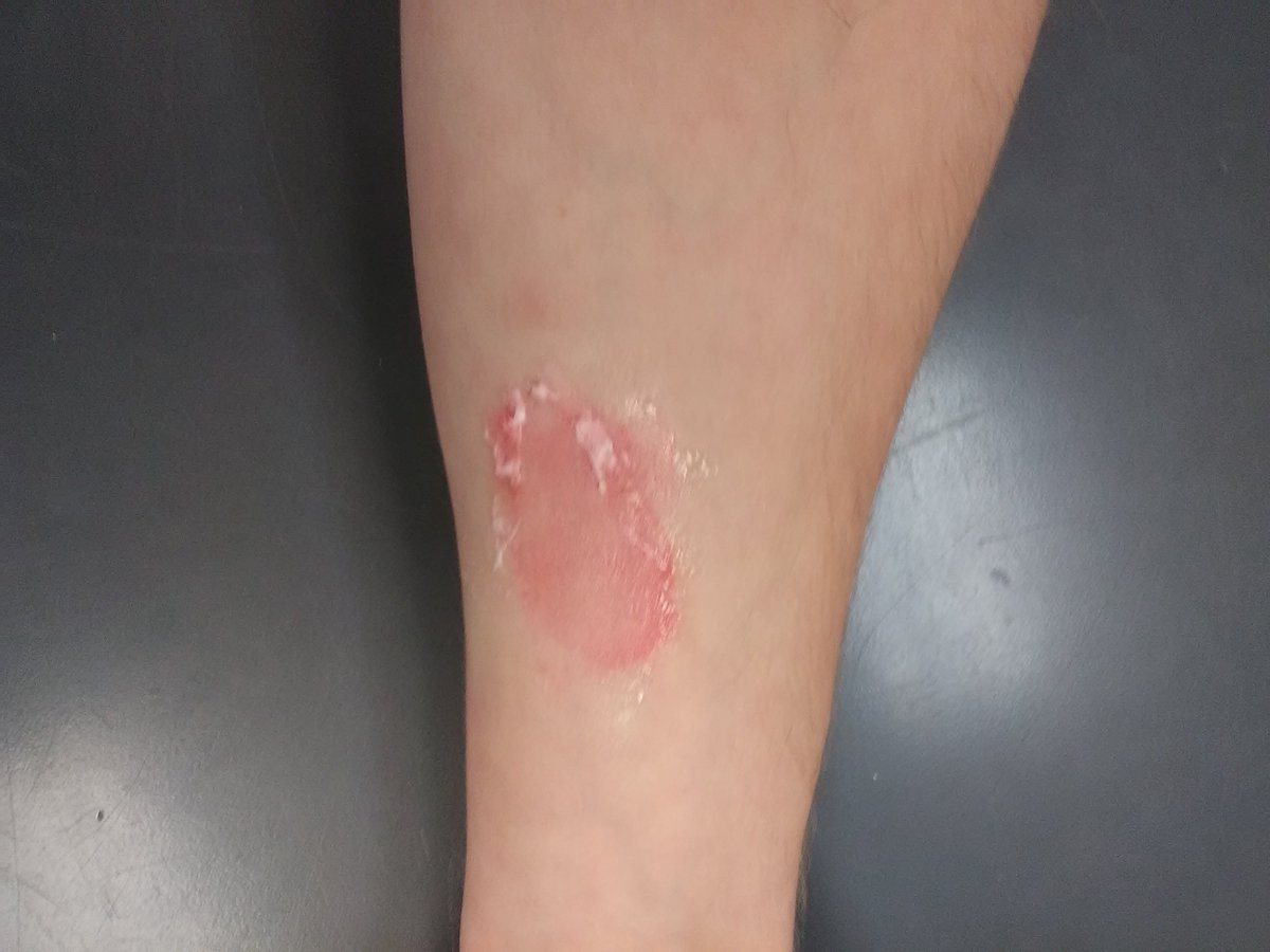 Scientist_Ben's tweet photo. #RHSBMS Our burns were second degree. You can tell this by the blisters and peeling in the photos. This type of burn is treated by keeping the wound clean and not popping the blisters. @MasonBrewer18 https://t.co/EWgNmetwP8