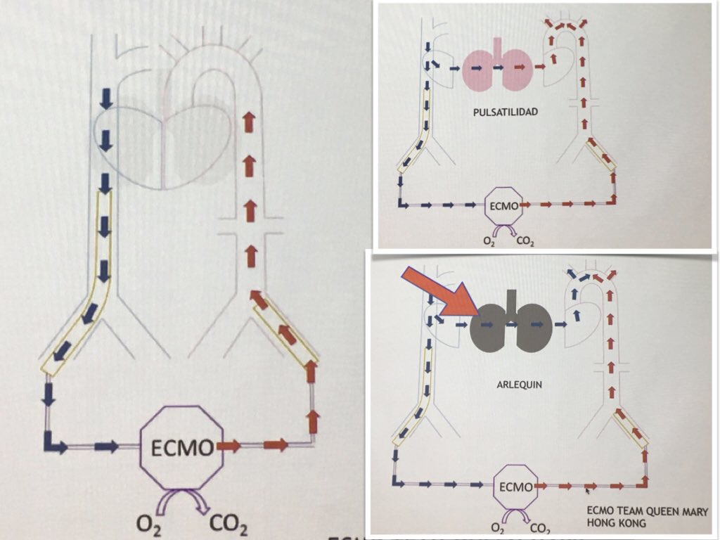 FOAMecmo's tweet photo. Cannulation for #ECLS Rodrigo Diaz @unidadecmoclc @ECMOed @ElsoLatam at #ECMOCLC the @ELSOOrg #ECMO consider pt size (BSA/CO-CI) vessels, physio deficits/demands & indications; cannulation is a dynamic process: switch as needed #FOAMcc #FOAMecmo Check app Suggested cannula size https://t.co/BpNeUzCmVQ