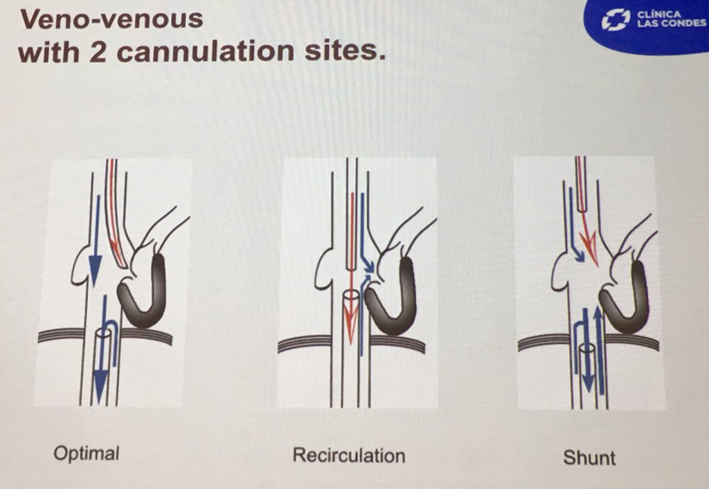 FOAMecmo's tweet photo. Cannulation for #ECLS Rodrigo Diaz @unidadecmoclc @ECMOed @ElsoLatam at #ECMOCLC the @ELSOOrg #ECMO consider pt size (BSA/CO-CI) vessels, physio deficits/demands & indications; cannulation is a dynamic process: switch as needed #FOAMcc #FOAMecmo Check app Suggested cannula size https://t.co/BpNeUzCmVQ