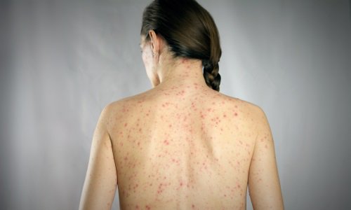 La #rougeole a provoqué deux décès cette année: un homme d’une 30aine d’année qui n’était pas vacciné et un homme d’une 70aine d’années qui était immunosupprimé en raison d’un cancer. L’OFSP rappelle que la #vaccination contre la rougeole est recommandée.
bit.ly/2LfOi5j