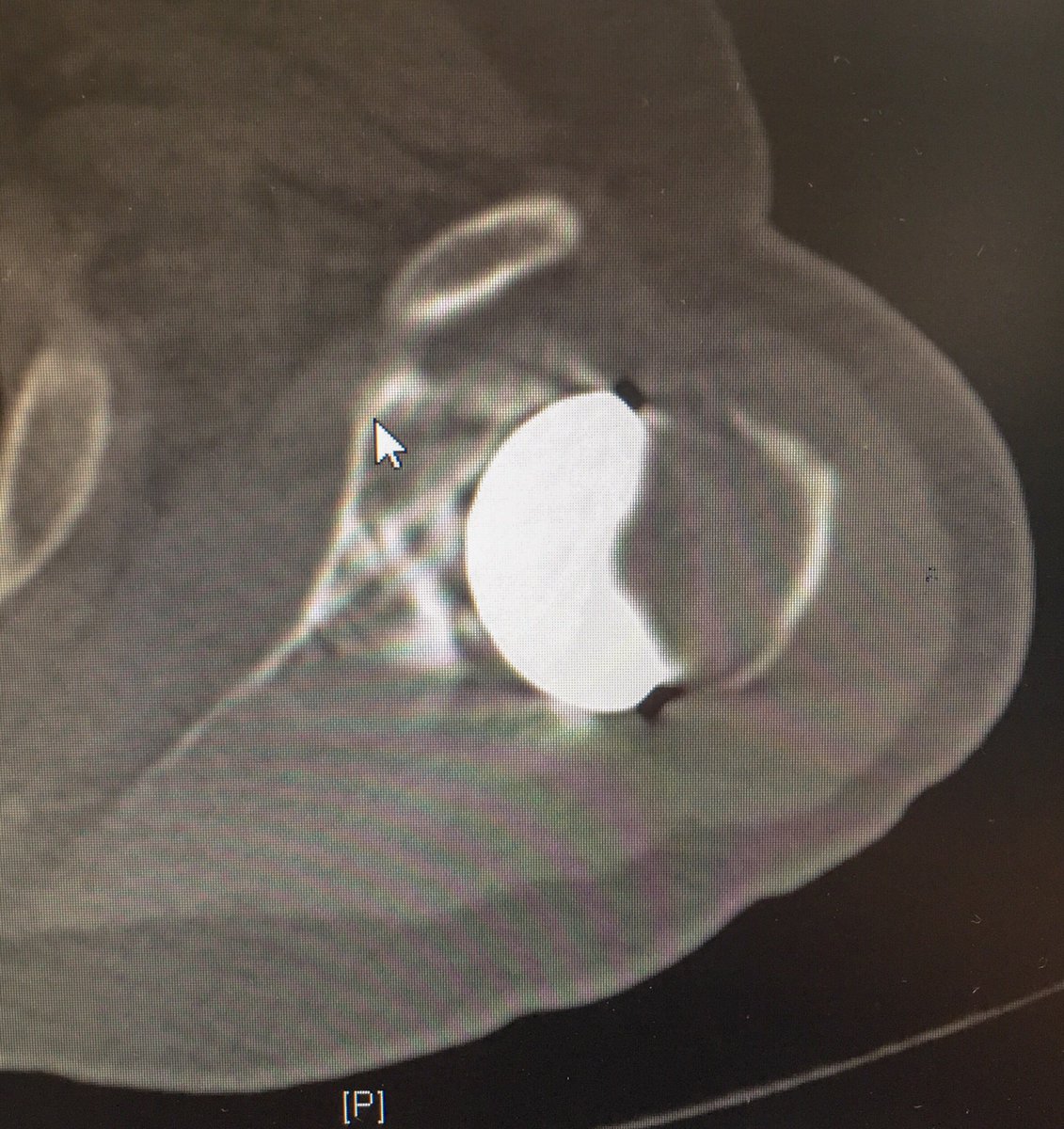 MrMikeWalton's tweet photo. First @wrightington16 @uplimb daycase custom revision shoulder replacement today with @drmricksy @thearmclinic #teamwork #lima #promade #glenoidboneloss https://t.co/s8QK0l59Qn