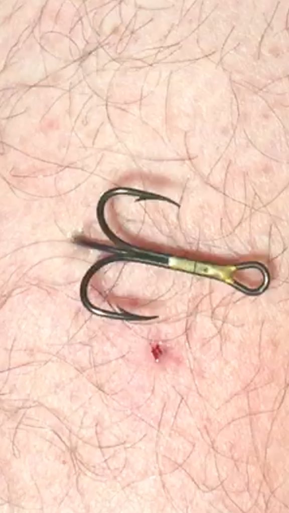 This video shows the best way to get a hook out youtu.be/n9cIR5q7I3c