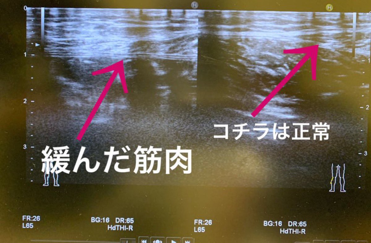 中村拓也 なかむら接骨院院長 どの筋肉のどんな損傷かしっかり調べて貰おうと思い病院受診しました エコー検査 の結果 腓腹筋 ふくらはぎの皮膚近くの筋肉 内側頭の肉離れでした 左側の矢印頂点部分が左右の腓腹筋を指しています 治療は患部を安定 中村拓也 なかむら接骨院院長 どの筋肉のどんな損傷かしっかり調べて貰おうと思い病院受診しました エコー検査 の結果 腓腹筋 ふくらはぎの皮膚近くの筋肉 内側頭の肉離れでした 左側の矢印頂点部分が左右の腓腹筋を指しています 治療は患部を安定