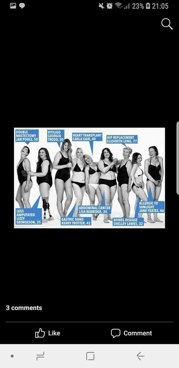 stomainateacup's tweet image. 2 years ago, almost 100 ostomates sent me pics for a body confidence campaign by the @loosewomen. Some images were shared on TV &amp;amp; I was honoured to take part in a shoot with @TheSun after being contacted by @ColostomyUK. 

#removingthestigma #ostomyawareness #ostomy #ostomate