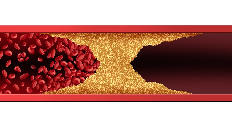De minister gaat zich buigen over ons verzoek om niet akkoord te gaan met de verlaging van de richtlijn voor LDL-cholesterol. De vaste Kamercommissie van Volksgezondheid, Welzijn en Sport heeft de minister gevraagd om een reactie op onze brief. Lees hier: bit.ly/2IXjsMC