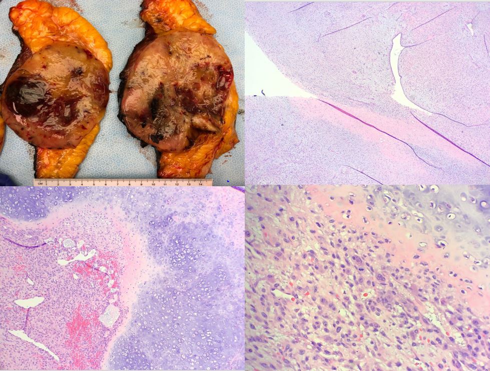 TexPathol's tweet photo. Breast mass with epithelial and stromal cells, with infiltrative borders, stromal overgrowth, nuclear atypia, abundant mitoses , necrosis, and heterologous elements in the form of chondrosarcoma and osteosarcoma were identified in this malignant phyllodes tumor. @HajaratTara https://t.co/PFd85UaMHu