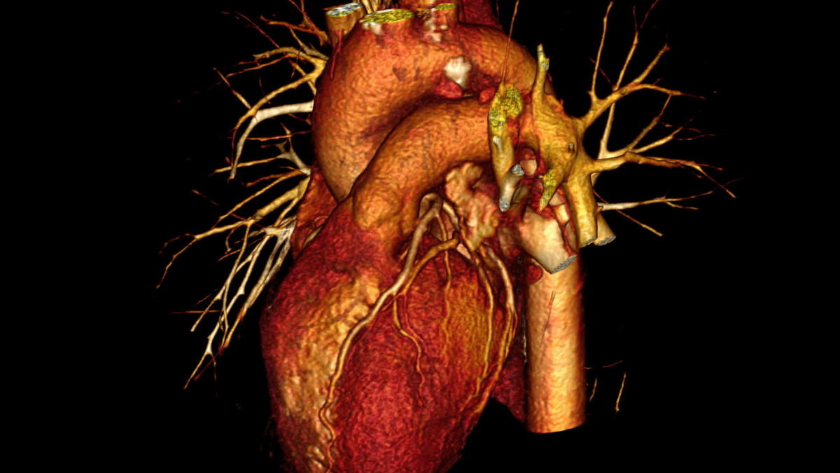 thespectrumsolu's tweet photo. 3D reconstruction of a CT scan of a human heart. Oh, you already KNEW that? Cool. Wait, you can DO that?!? Awesome. Want a sweet new job? SOFTWARE DEVELOPER needed. Carly@TheSpectrumSolution.com for details.
#medicalimaging #softwaredevelopment #savinglives #thespectrumsolution https://t.co/GUHu8kskfm