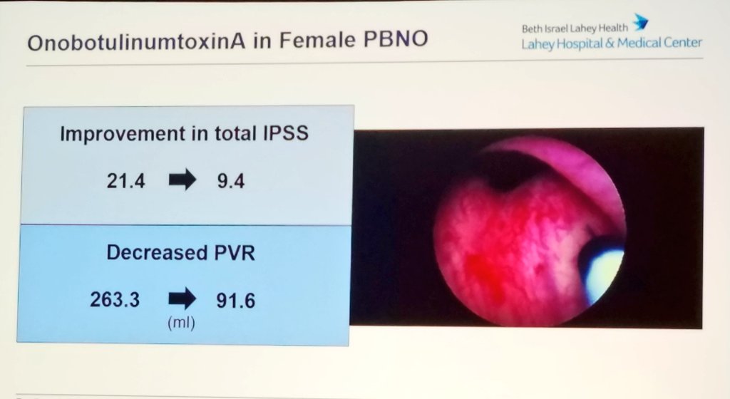 Rena Malik, MD | Urologist (@renamalikmd) on Twitter photo Potential future use of 200 units of onabotulinum toxin A in 4mL injected in 4 quadrants to treat primary bladder neck obstruction in🚺 <a href="/MacLachlanLara/">Lara MacLachlan</a> #SUFU19 at #AUA19 Potential future use of 200 units of onabotulinum toxin A in 4mL injected in 4 quadrants to treat primary bladder neck obstruction in🚺 <a href="/MacLachlanLara/">Lara MacLachlan</a> #SUFU19 at #AUA19