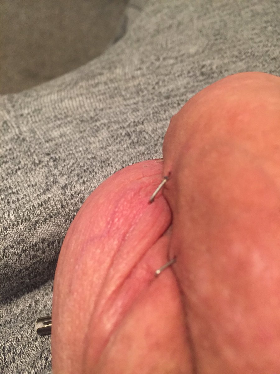 ButlerJonBoy's tweet photo. There will be no more sudden movements from me for a while as @MistressJay1 has stapled my cock to my ball bag π©#cbt #medicalstaples #chastity https://t.co/OaHYfP3fAC