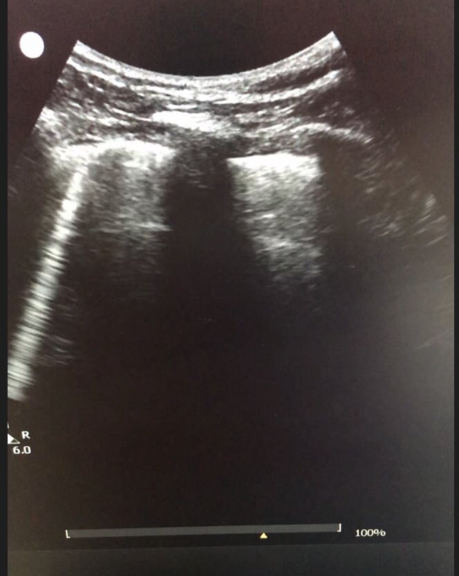 PhilWARussell's tweet photo. And within 10 hours of finishing the course, first diagnostic lung USS performed! Patient hypoxic, febrile and tachycardiac. Clear pathology demonstrated, pointing towards bilateral pneumonia! Thank you all again!! #practicewhatyoutweet https://t.co/ZpYL81dijg