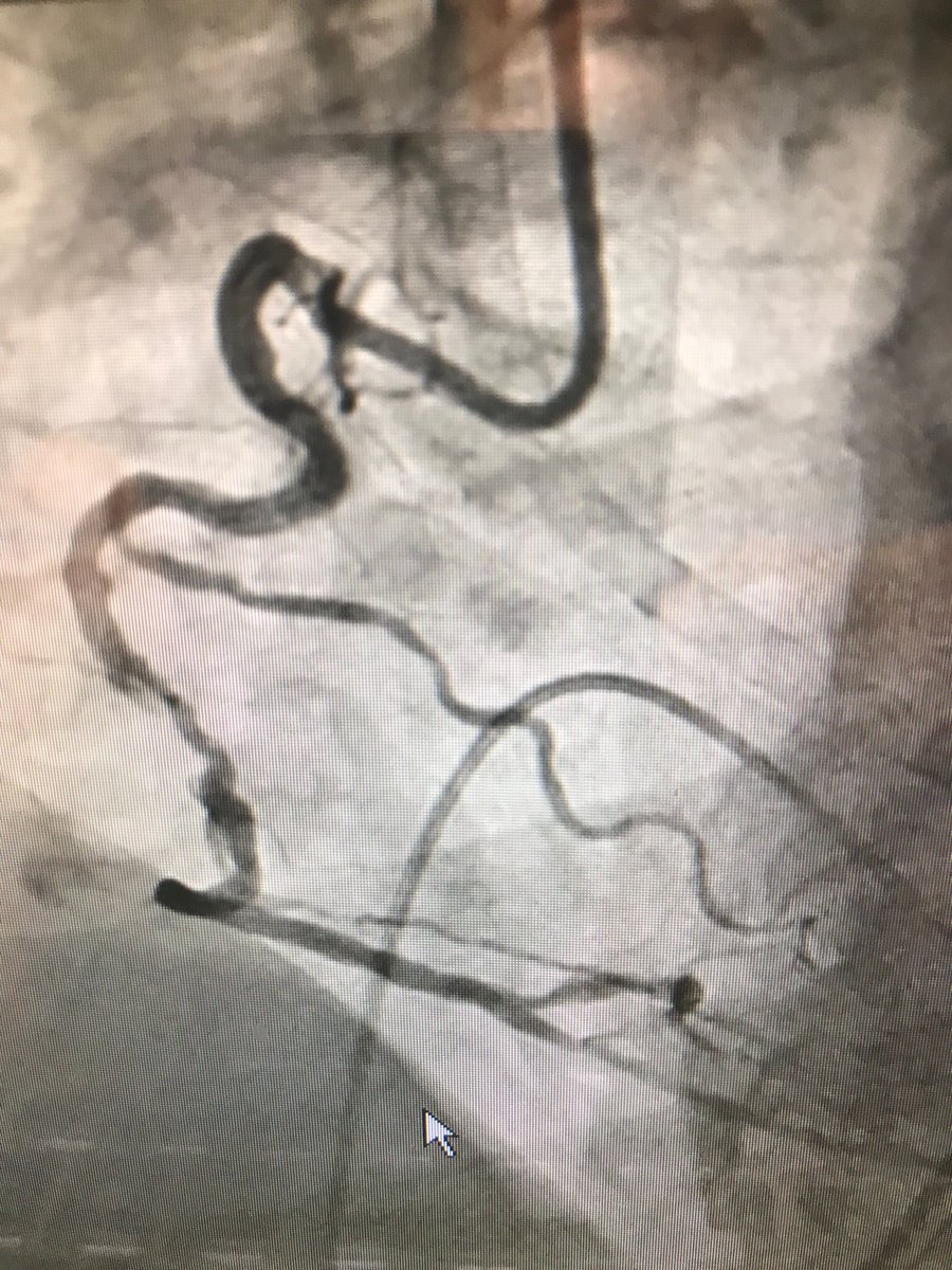 istentem's tweet image. #Safefemoral #protectedpci #impella #preclose 70m ef 30 pci rca only viable vessel tvp 7f AR2,#guidezilla 2 fielder xts .chb bp60 after predil&amp;gt;2DES&amp;gt;home next day