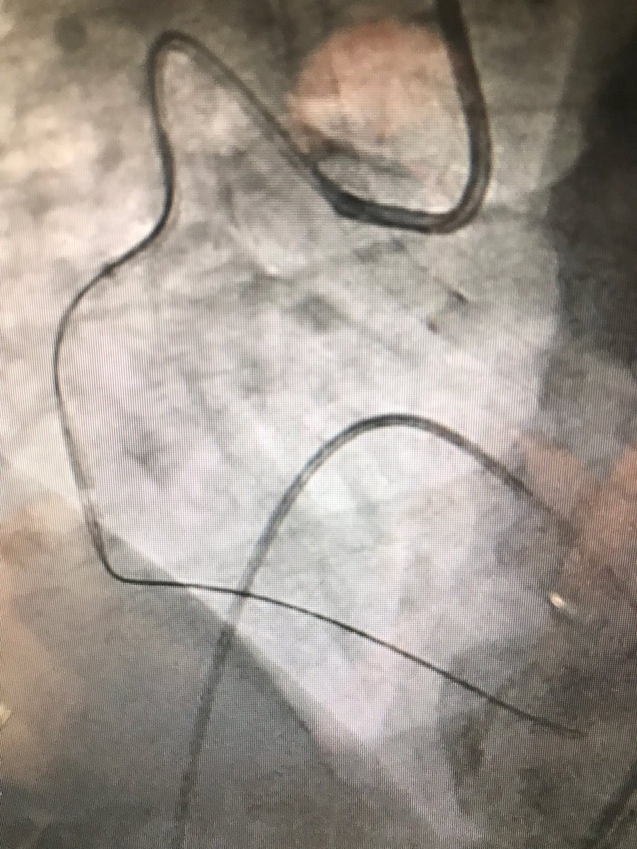 istentem's tweet image. #Safefemoral #protectedpci #impella #preclose 70m ef 30 pci rca only viable vessel tvp 7f AR2,#guidezilla 2 fielder xts .chb bp60 after predil&amp;gt;2DES&amp;gt;home next day