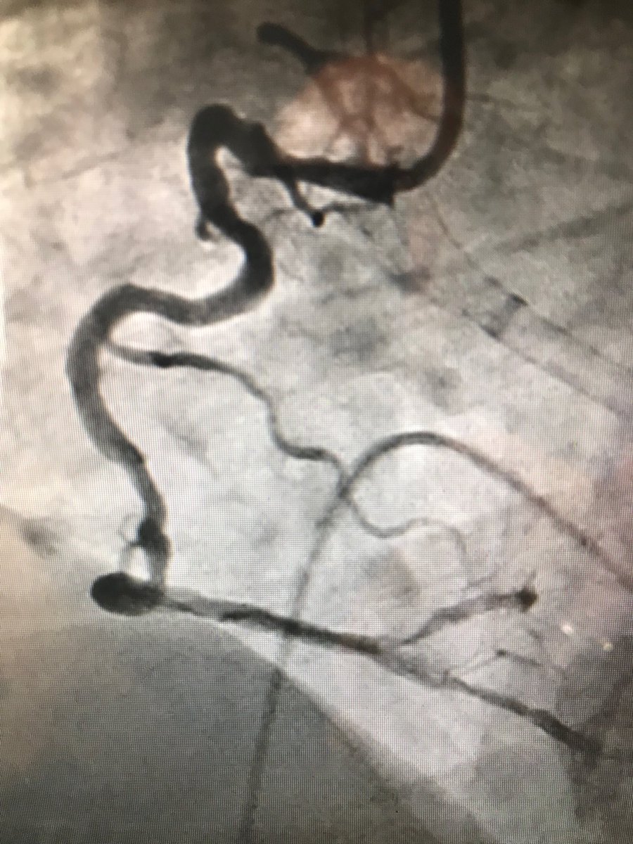 istentem's tweet image. #Safefemoral #protectedpci #impella #preclose 70m ef 30 pci rca only viable vessel tvp 7f AR2,#guidezilla 2 fielder xts .chb bp60 after predil&amp;gt;2DES&amp;gt;home next day