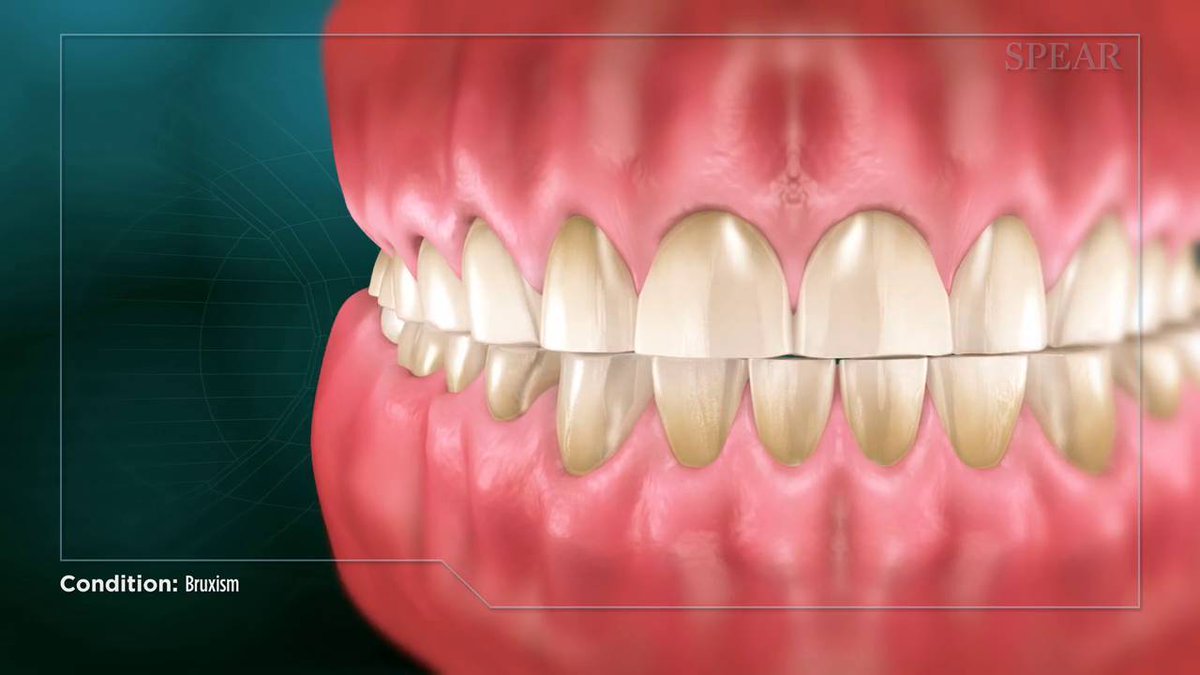 Сильно сжатые зубы. Бруксизм скрежетание зубами. Бруксизм стирание зубов. Патологическая стираемость зубов.