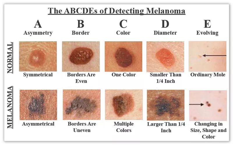 agmcmasters's tweet photo. Detecting melanoma early is key to survival. Become familiar with the "A-B-C-D-E-F &amp; G's" of what &amp; how the warning signs exhibit in melanoma. If anything looks or feels questionable, please visit a dermatologist. When in doubt ~ get it checked out! 🖤 #melanoma #cancer https://t.co/1JtzasmzxO