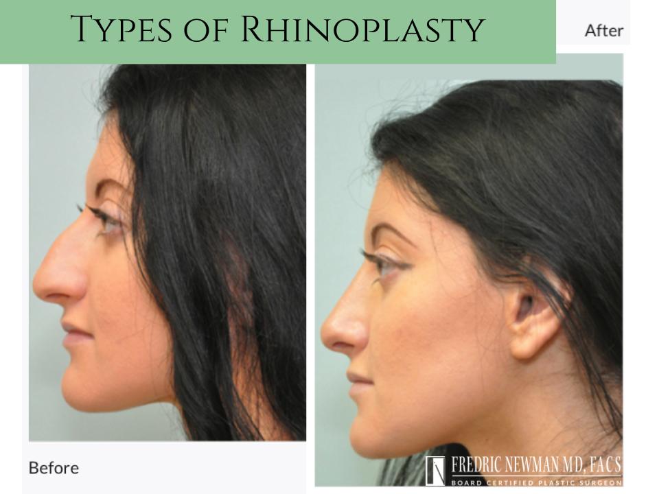 There are two types of #rhinoplasty: open and closed. Dr. Newman will use one of the two when performing your procedure, taking into consideration your specific situation and goals for nose surgery ==> fredricnewmanmd.com/face/rhinoplas… #Darien, CT