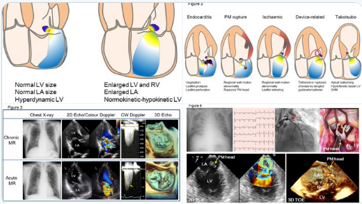 JCORHEARTDIS's tweet photo. #Cardiology #Cardiotwitter #EchoFirst #heartsurgery #ESCACCA https://t.co/OtfAyVZpji