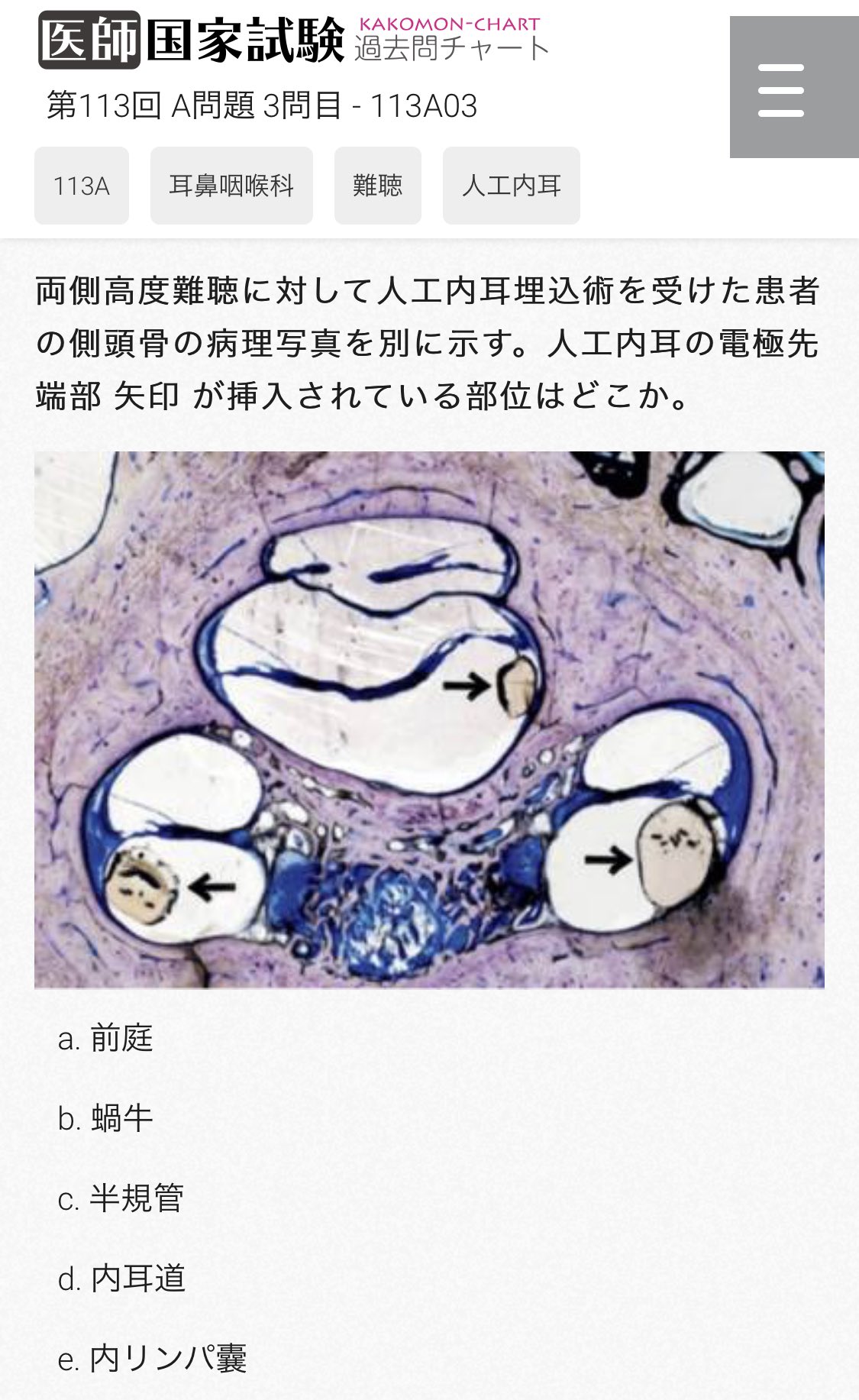 医学語呂なう On Twitter 問題 両側高度難聴に対して人工内耳埋込術を受けた患者の側頭骨の病理写真を別に示す 人工内耳の電極先端部 矢印 が挿入されている部位はどこか Https T Co Ceamblhi1m