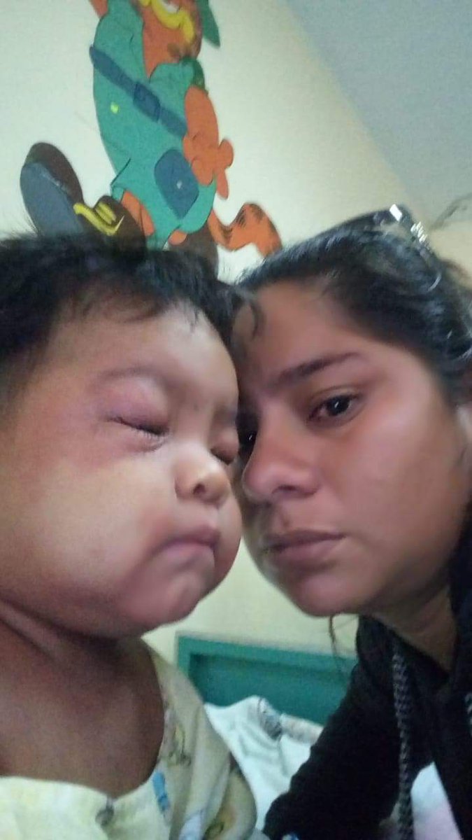 FloresTarrillo's tweet image. Lamento colocar la foto sin censura. Se llama Dylan, tiene un año y se encuentra en el hospital Rezola de Cañete. Padece la enfermedad de Steven Johnson. Ha sido rechazado por casi todos los hospitales, incluído el @INSN_oficial "por falta de cupo".
#AyudemosaDylan