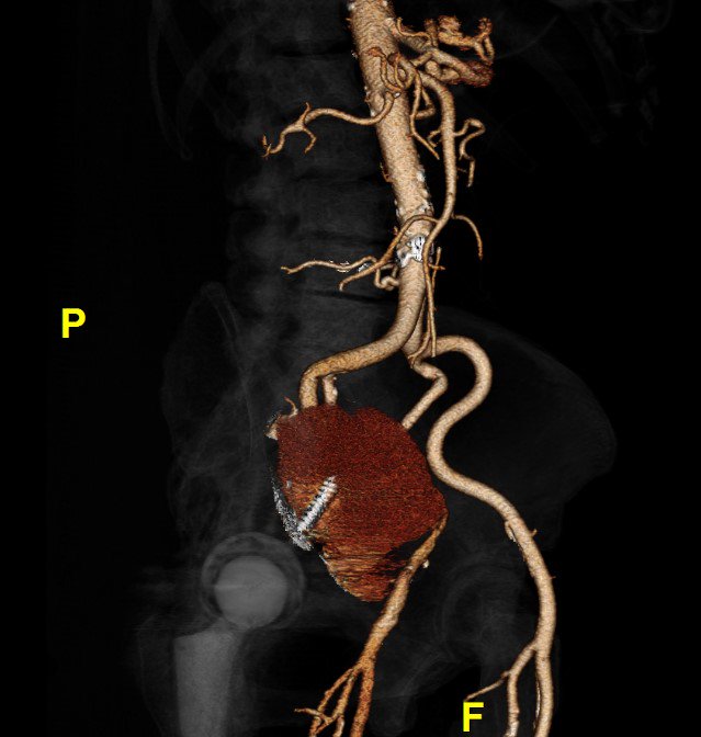 A month earlier, she’d been found to have a large pseudoaneurysm arising from her external iliac artery.(And yes, that’s a screw from a previous hip replacement traversing it.)She underwent stenting and returned home./4