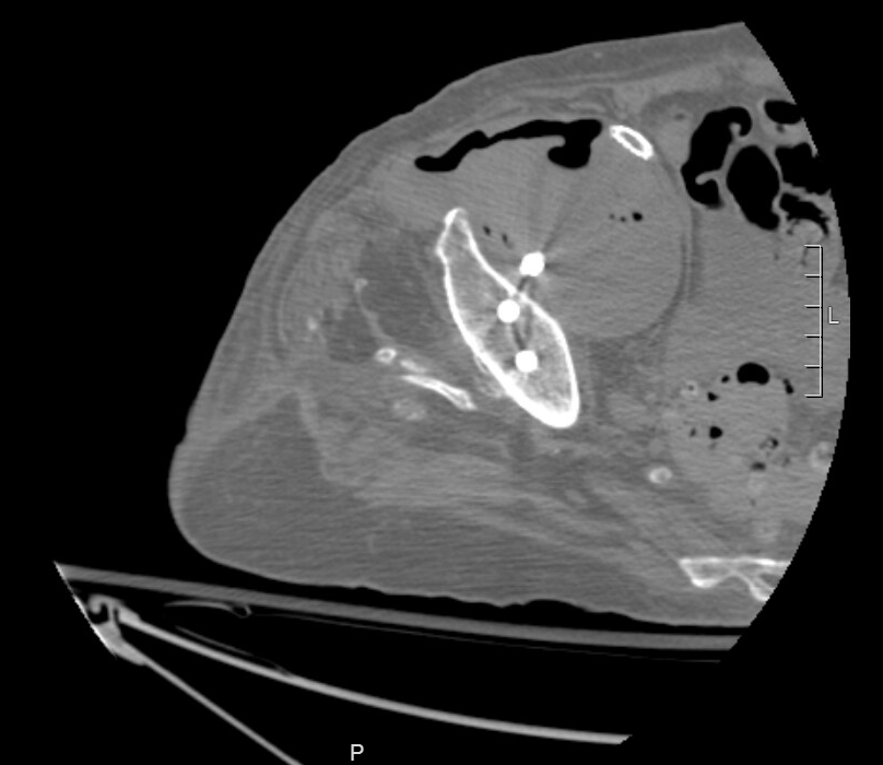 Because she was septic and in pain, we scanned her again. The new CT showed extensive gas within the pseudoaneurysm.It was now infected, and that was a big problem./5