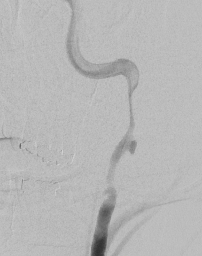 UofUNIR's tweet photo. 28 y/o w/ L ICA injury after MVC. Sent from OSH d/t to embolic stroke to the L hemisphere. Reconstruction of left ICA w/ overlapping stents. #Level1TraumaCenter @UofUHealth provides advanced capabilities for patients w/ traumatic vascular injuries. #StrokeSurvivor #StrokeMonth https://t.co/2tcNasUHf0