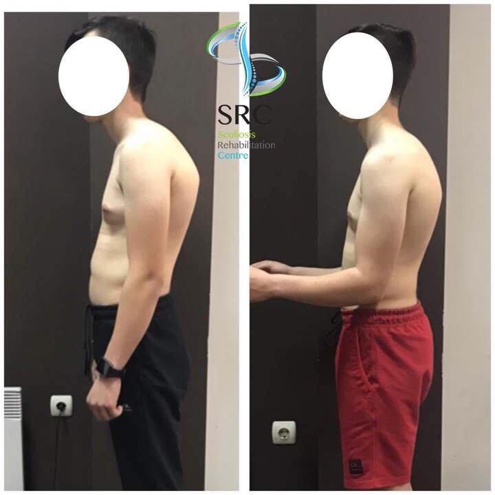 ScolioCentar's tweet image. Upornost i istrajnost u radu se uvek isplate! Pozitivni rezultati nam daju snagu da budemo jos bolji! 😊💪🏻
#scoliocentar #kyphosis #schrothmethod