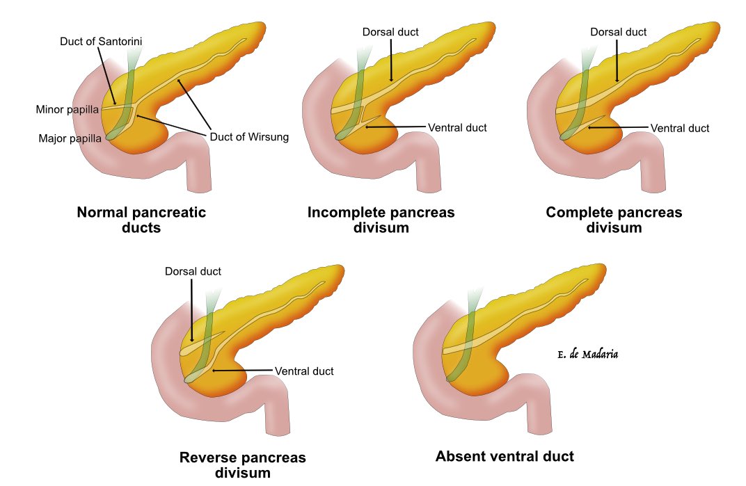 What is the clinical importance of pancreas divisum? @my_ueg #UEGambassador @aegastro @EurPancClub @hpb_so @me4_so #EndoSoMe @SEEDendoscopia #PancreasHGUA @DHgua #Pancreatitis 👇🏻👇🏻👇🏻