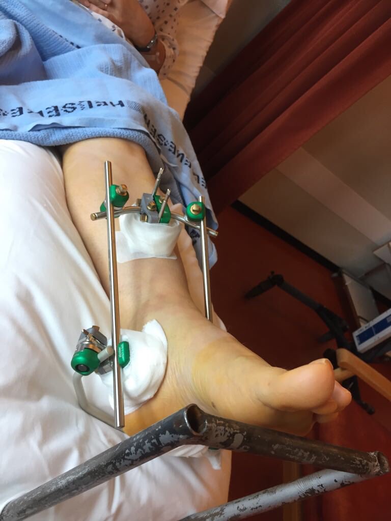 BirgitMW23's tweet photo. One year after #weber3 functionality almost fully restored thanks to Harald Hugenschmidt, #SørlandetSykehus, #physio and #rehabilitation @UWCRCN https://t.co/tLyI0xxPLN