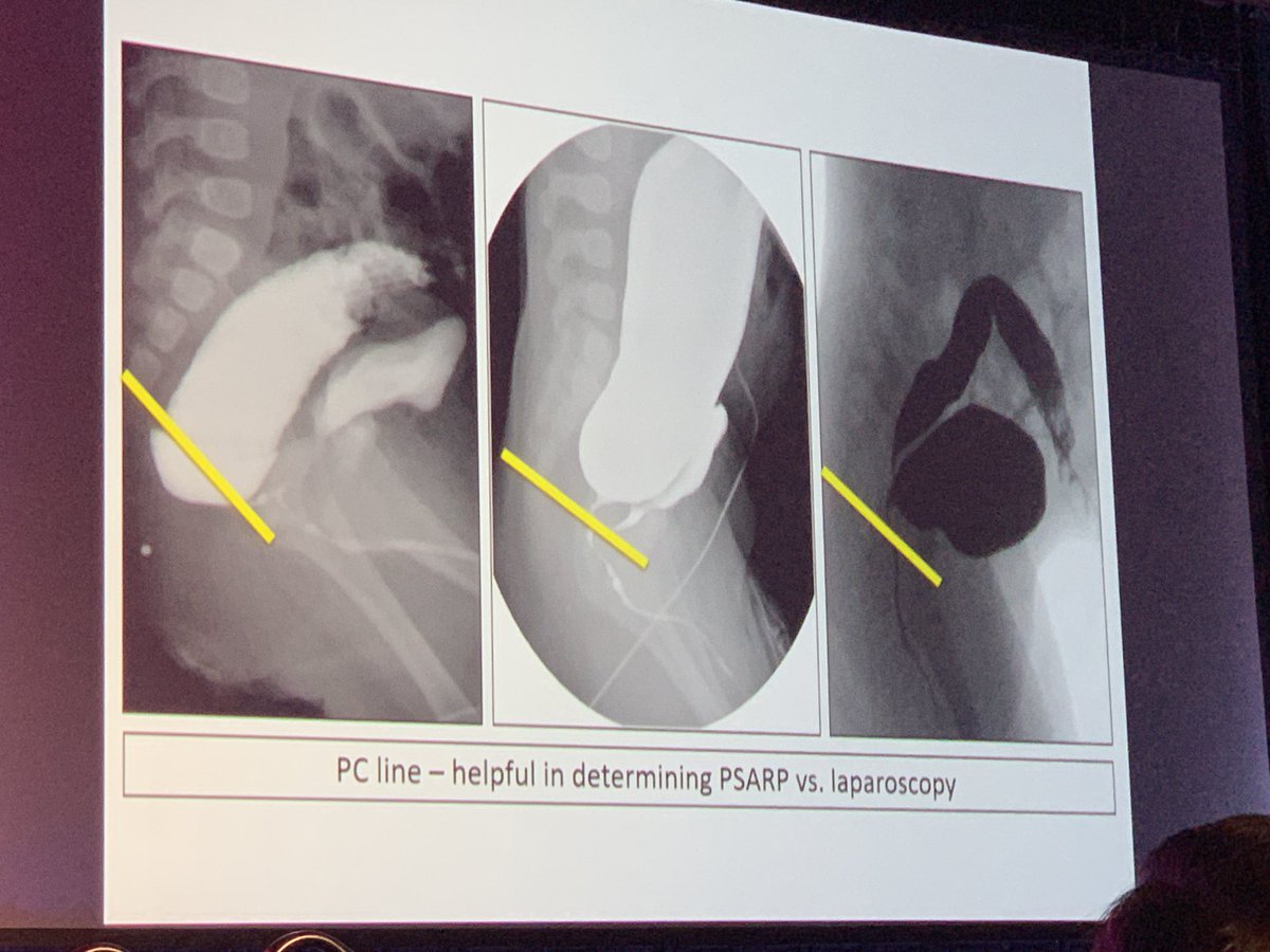 Don’t forget the PC line.  PSARP VS Laparoscopy @APSASurgeons #anorectalmalformation #APSA50