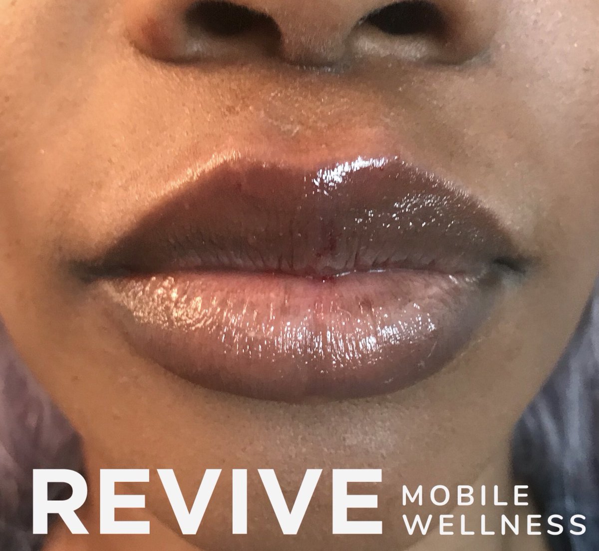 ReviveMobile's tweet image. This beauty had a very specific lip shape and style in mind. 
She wanted a sharpened Cupid’s bow, vermillion border and philtrum definition without adding any more volume to the lower lip.  I tailored my injection techniques to accomplish this and look at this beautiful outcome!