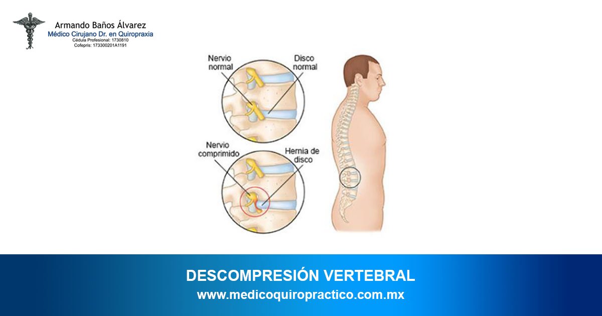QuiropracticoAB's tweet photo. La descompresión vertebral es una terapia no invasiva e indolora que trata las hernias discales con la tecnología médica más avanzada. Presenta altísimos porcentajes de éxito.
#Quiropráctico #Salud #Bienestar COFEPRIS: 173300201A1191 https://t.co/dyMEsQDSrU
