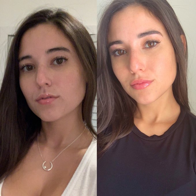 1 pic. How can anyone say the before is better .... like no way . Lips are def. a game changer idc what