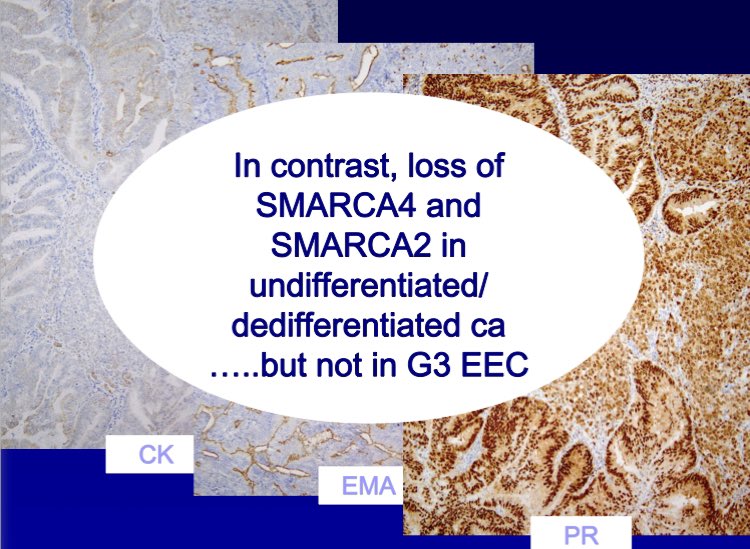 huda_rr1's tweet photo. @slusagar Great case as usual๐๐ผ I find it difficult to ddx from high grade endometroid ca. These are a couple slides from Dr. Esther Olivaโs talk during #HKIAP to help with this issue. https://t.co/CZSId72RQZ