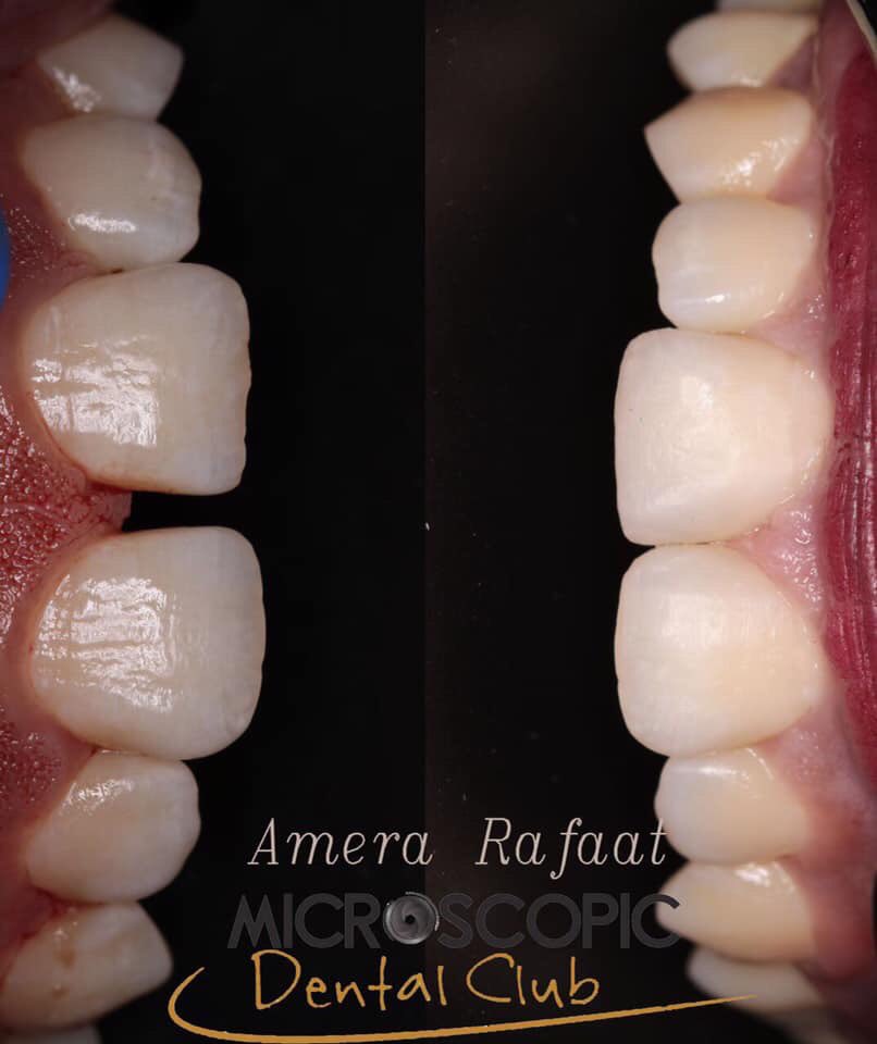 faridai04855440's tweet image. #still_learning
#learning_curve
#customization_for_the_masters
#take_ur_skils_to_the_next_level 🦷
  Full case facebook.com/amera.rafaat.52