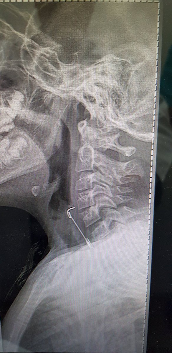 Siempre hay que mantener cultura de seguridad en el hogar, poniendo a buen recaudo objetos peligrosos y alejados de los niños.