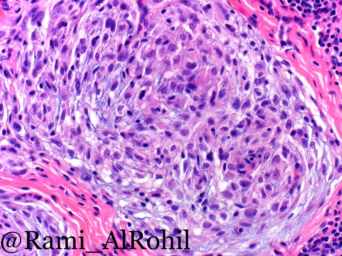 Cellular neurothekeoma: solitary lesion, young age group, mostly females on the head&amp;neck. Multilobular pattern in a fibrotic/hyalinized stroma, lobules composed of round cells with vesicular chromatin arranged in concentric nests that swirl w/ some mucin #Pathology #Dermpath