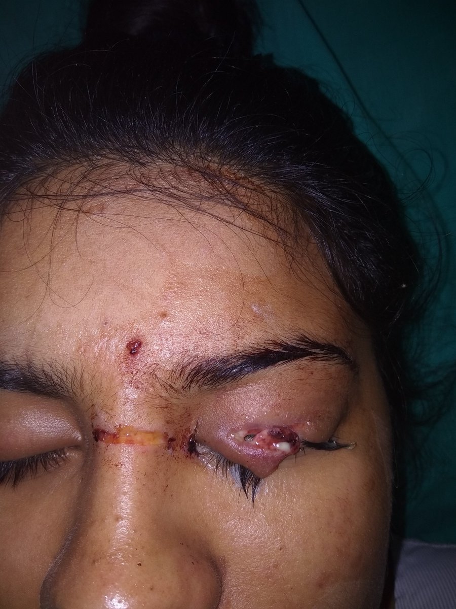 Northexsurgery's tweet photo. Eyelid injury caused by a pet dog.
And the surgery is done by our female plastic surgeons (Dr. Anju Goswami &amp; Dr. Sunit Kaushik) at our @Northexsurgery center #Eyelid_surgery #plastic_surgery #female_surgeon #cosmetic_surgery #eyelashes #treatment https://t.co/yBdW2A8I2T