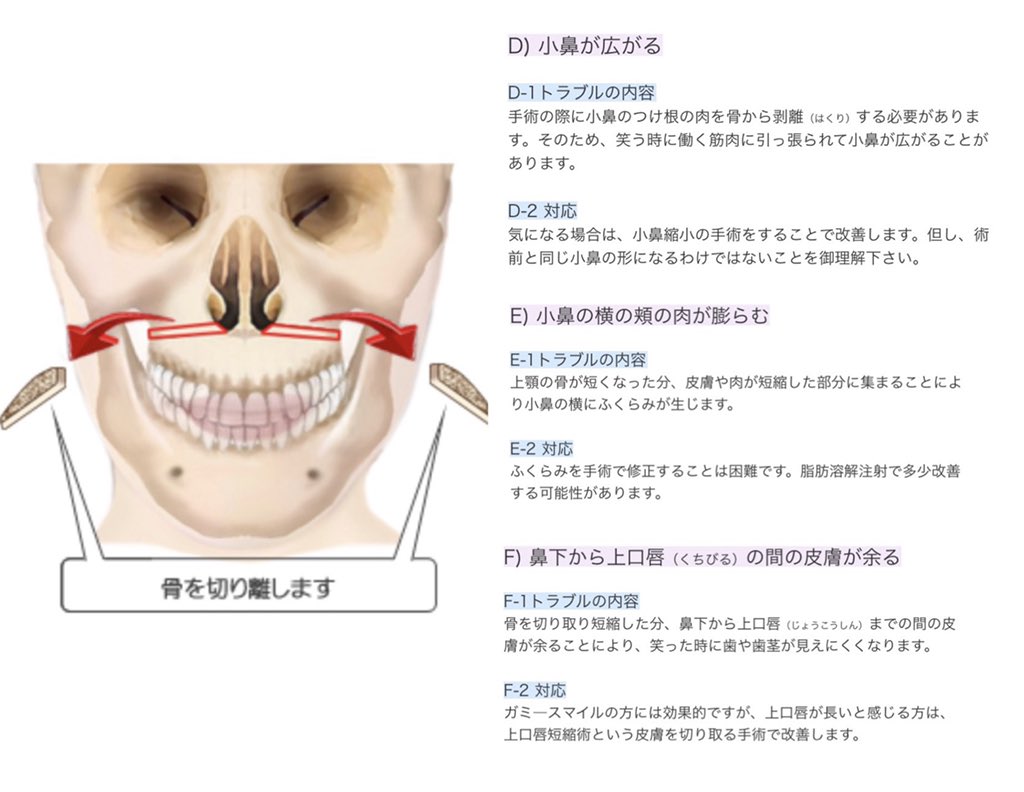 ぱにたん 私が悩んでいる手術後の小鼻の広がり 顔の肉の盛り上がり 歯が見えにくい問題の原因がわかったかも 鼻の修正と肉の調整と皮膚の調整 全ての工程が終えて始めて完成といえるのかも ぱにたん 私が悩んでいる手術後の小鼻の広がり 顔の肉の盛り上がり 歯が見えにくい問題の原因がわかったかも 鼻の修正と肉の調整と皮膚の調整 全ての工程が終えて始めて完成といえるのかも