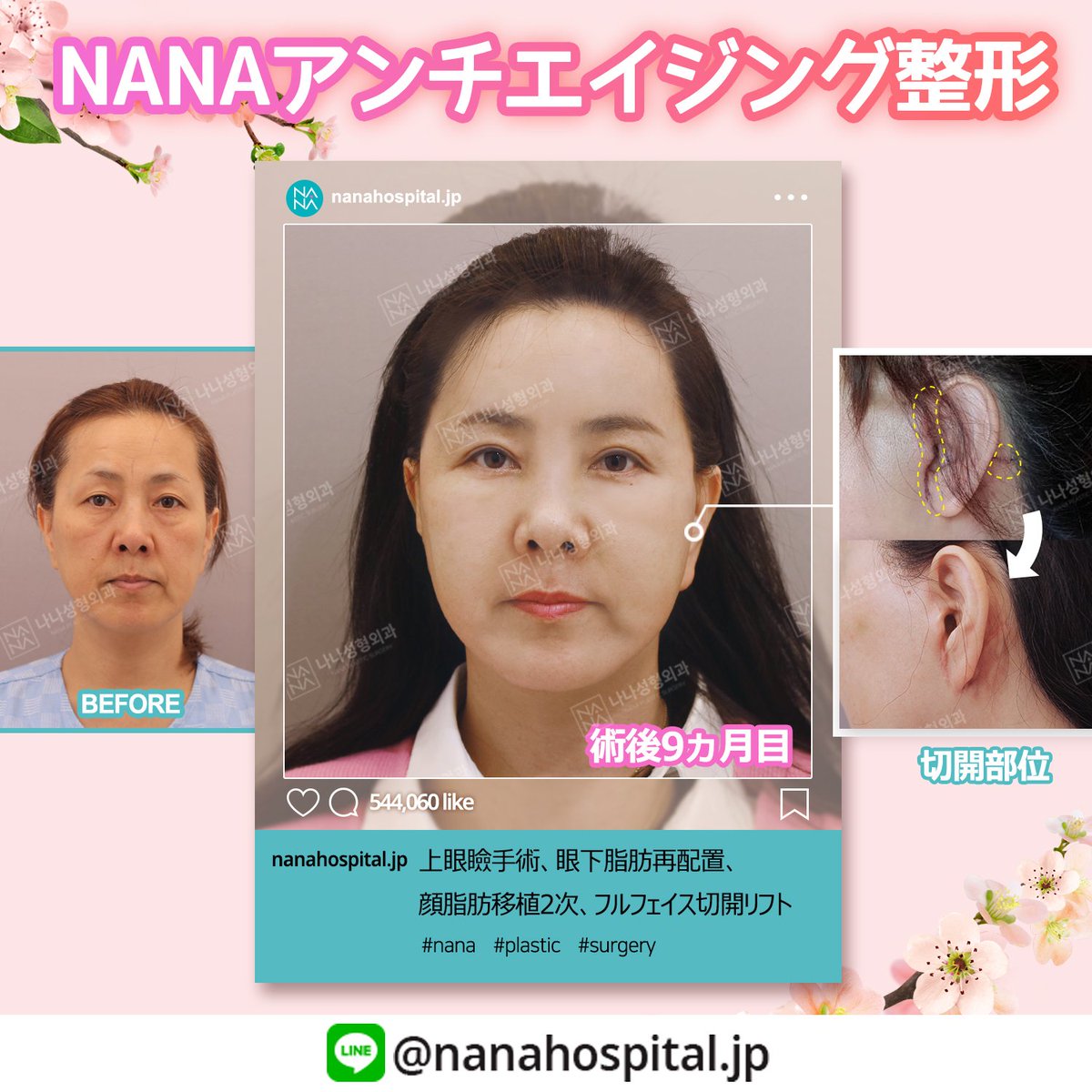 韓国nana美容整形外科 V Twitter Nanaアンチエイジング整形 手術内容 フルフェイス切開リフト 上眼瞼手術 眼下脂肪再配置 顔脂肪移植 2次 お問合せはlineまで Line Nanahospital Jp 韓国美容外科 韓国整形 韓国リフト 切開リフト 童顔 若返り