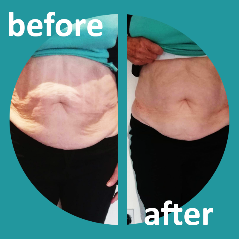 ShapeSculptors's tweet photo. #WednesdayMotivation!
Because great things never came from #comfortzones.
Check out another #client'sprogress here at #shapesculptors! 😱🥳
Get out of that #comfortzone with shape sculptors and #trysomethingdifferent!
#Youwontregretit
#beforeandafter #tummy #happclient #ftiness https://t.co/kbrVWA92ta